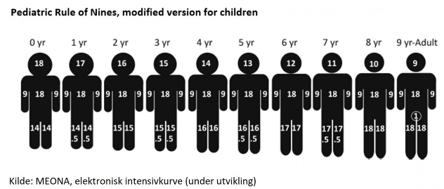 Modifisert 9-er regel for barn — kroppsoverflate